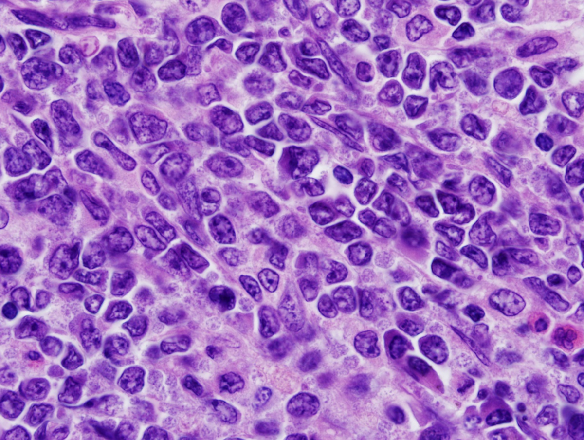 BM biopsy 2 core 100x